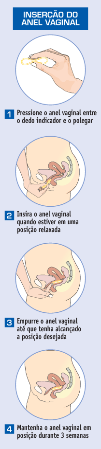 InserÃ§Ã£o do anel vaginal com dapivirina (DPV-VR) para prevenÃ§Ã£o do HIV (PrEP)