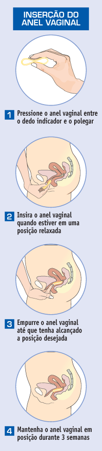 Inserção do anel vaginal com dapivirina (DPV-VR) para prevenção do HIV (PrEP)